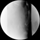Tumour and fistula of the urinary bladder, fistula of small bowel, fistulography: RF - Fluoroscopy